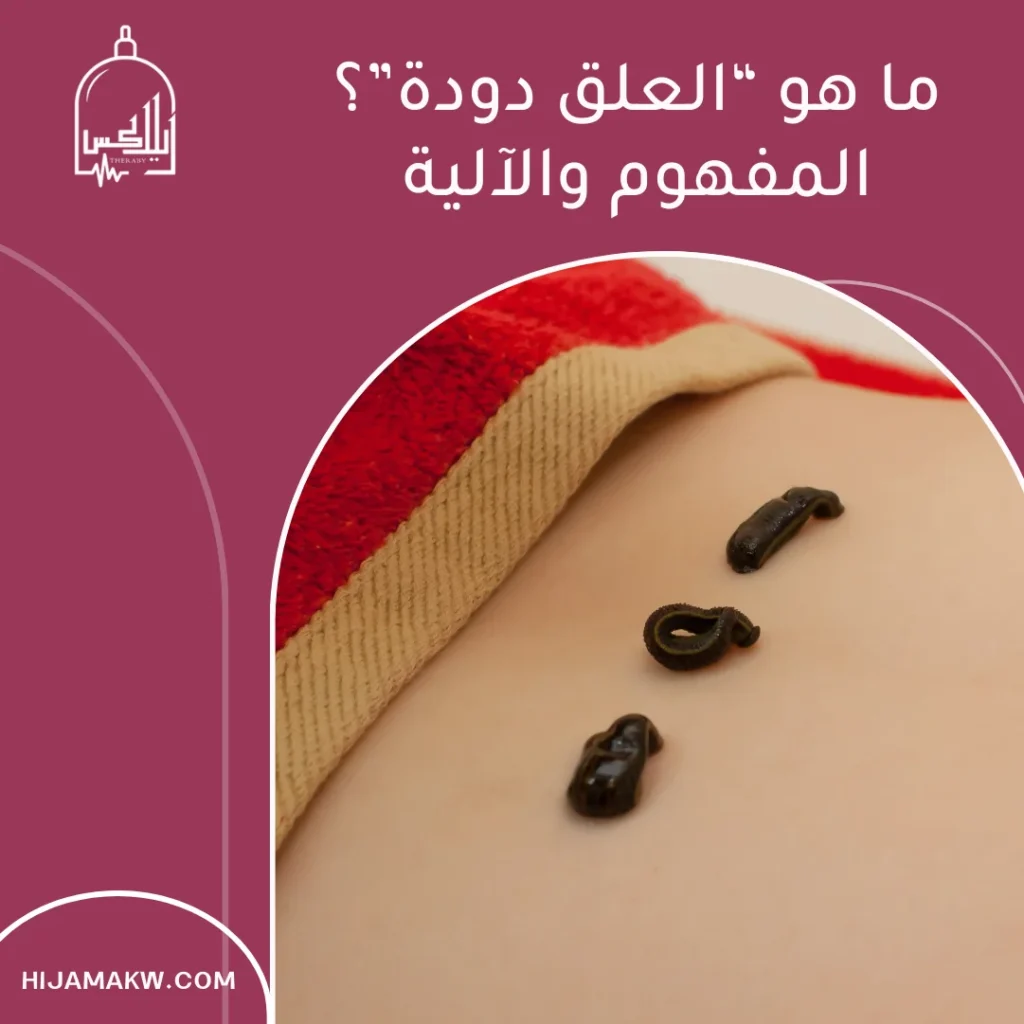 العلق دودة