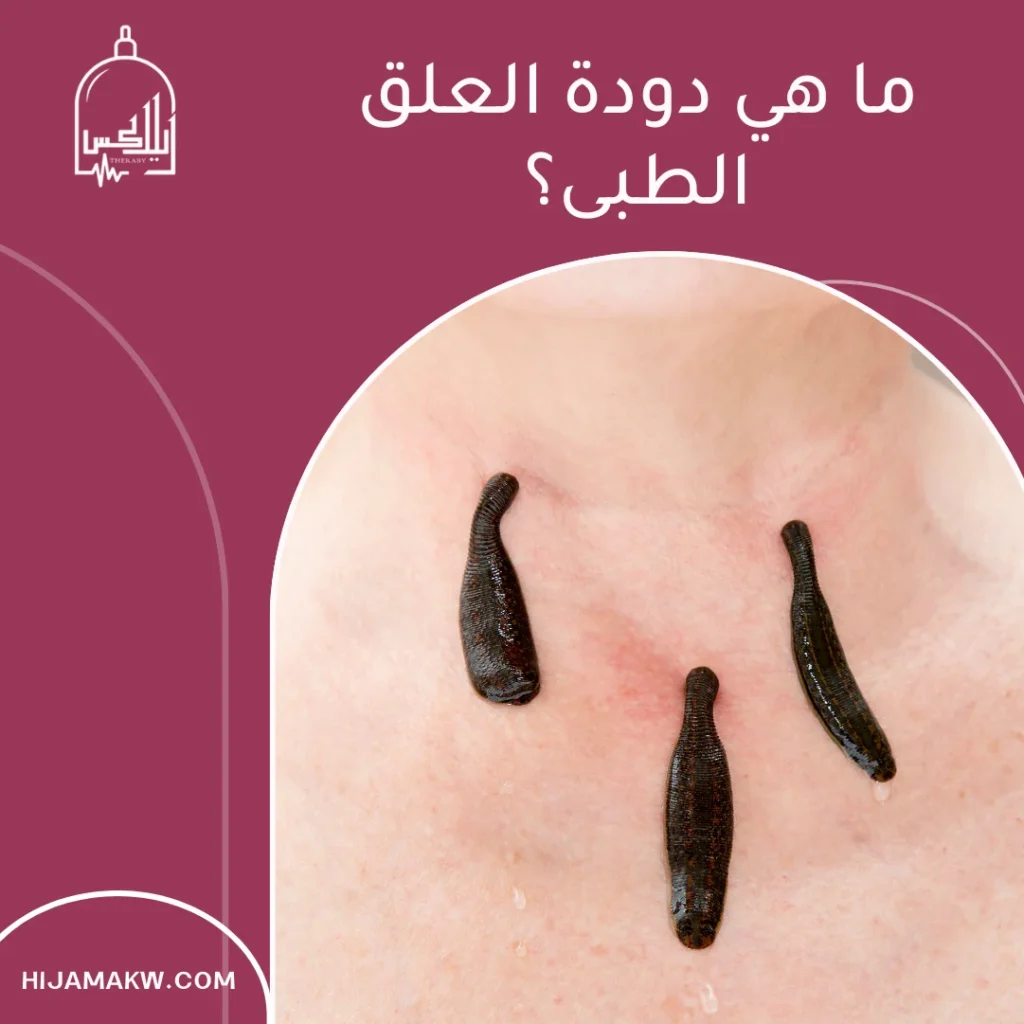 دودة العلق الطبى