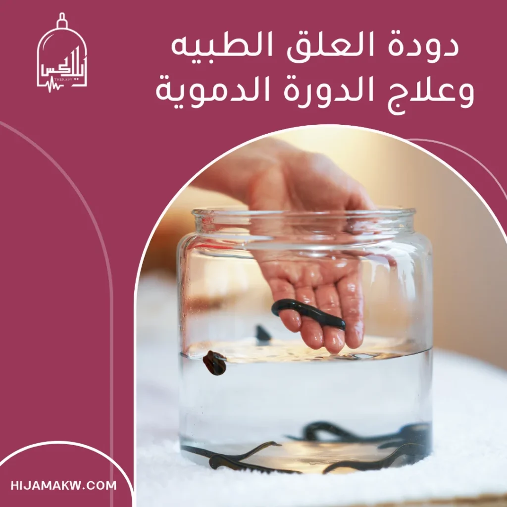 دودة العلق الطبيه