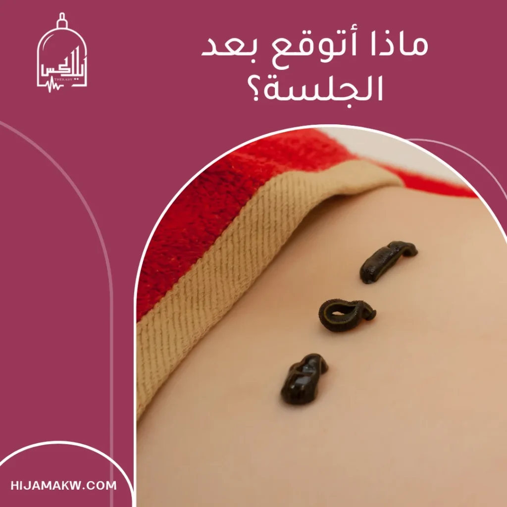 العلق دودة