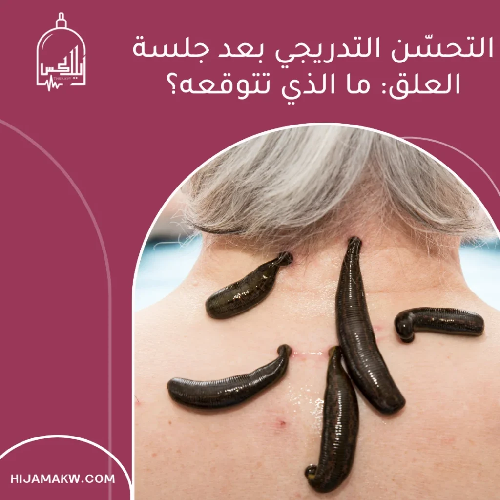 معلومات عن دودة العلقة