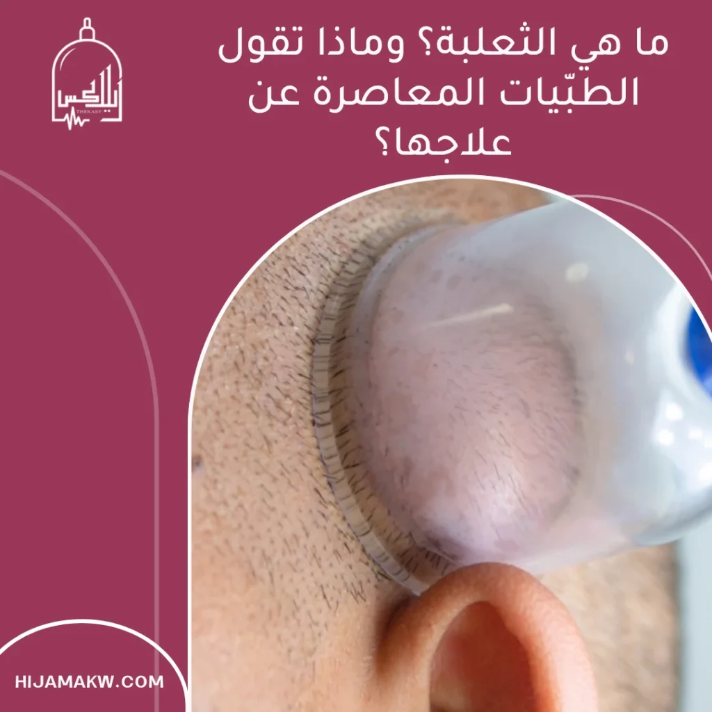 علاج الثعلبة بالحجامة: ما الذي نعرفه فعلاً؟ دليل عملي لسكان الكويت 50508666 علاج الثعلبة بالحجامة