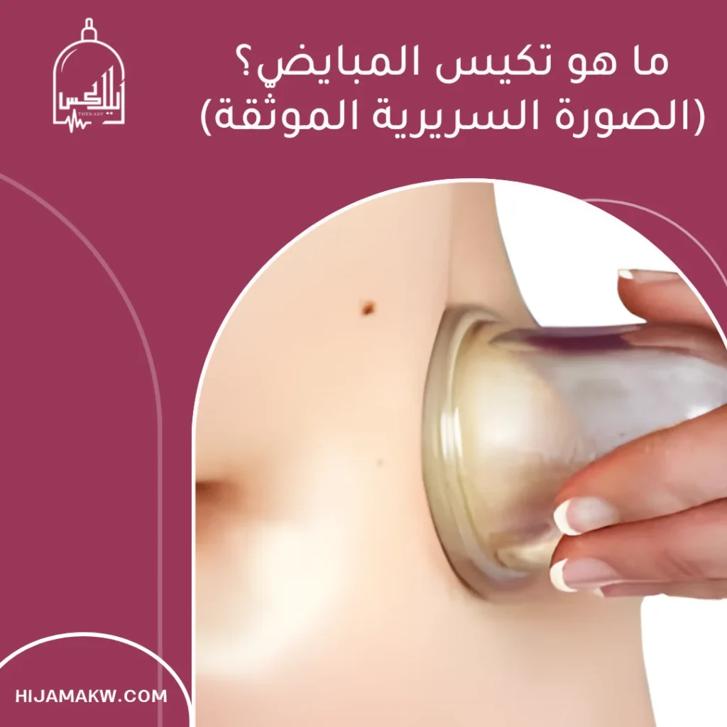 علاج تكيس المبايض بالحجامة: دعم إضافي تحت مظلة السلامة 50508666 علاج تكيس المبايض بالحجامة