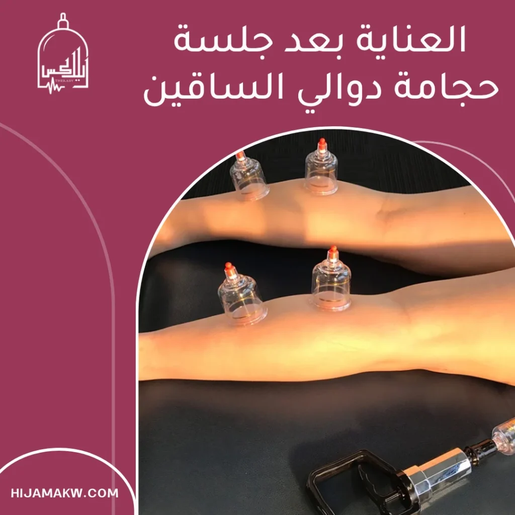 حجامة دوالي الساقين في الكويت: فهمٌ أوضح وخيارات أكثر أمانًا 50508666 حجامة دوالي الساقين