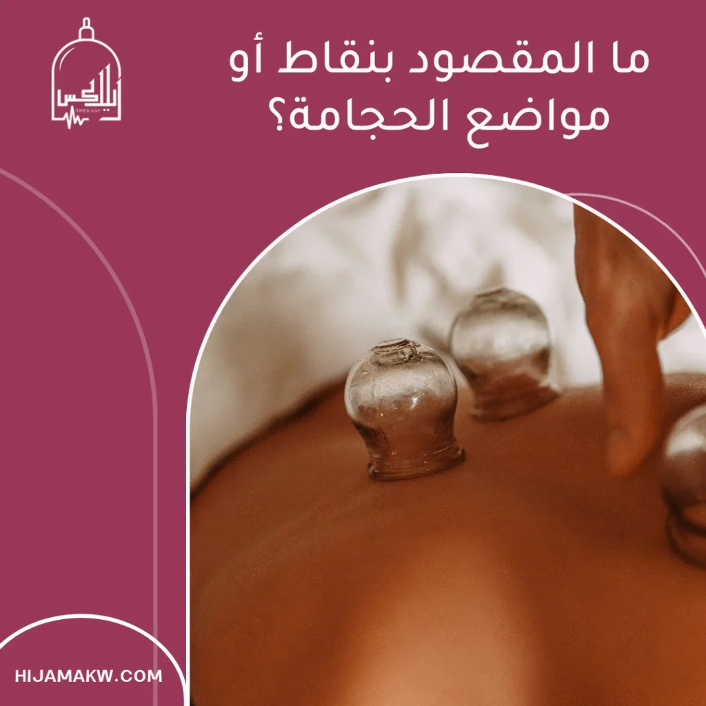 نقاط الحجامة لعرق النسا