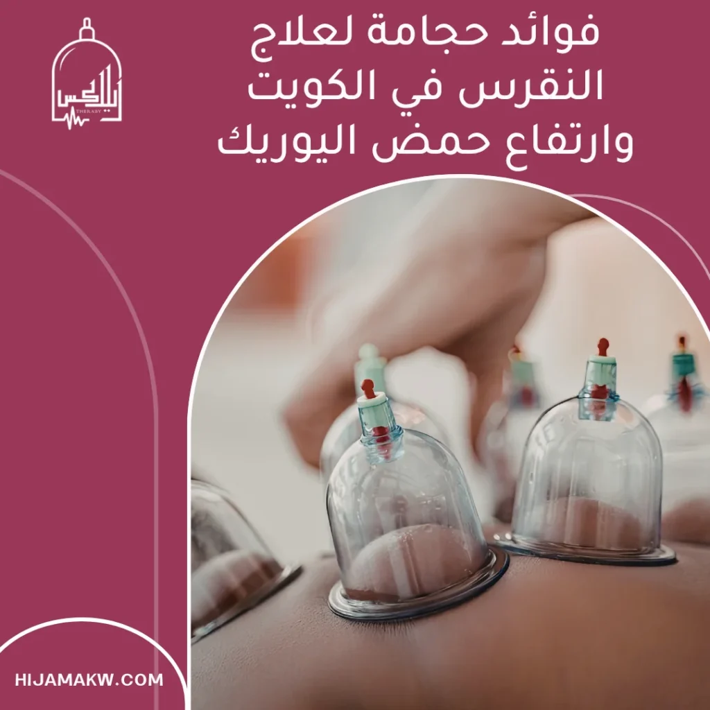 حجامة لعلاج النقرس في الكويت