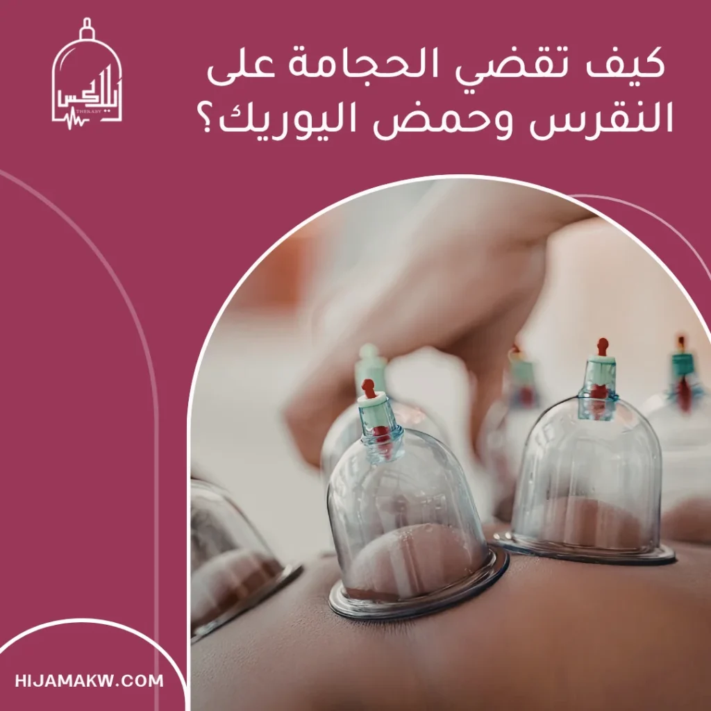 حجامة لعلاج النقرس في الكويت